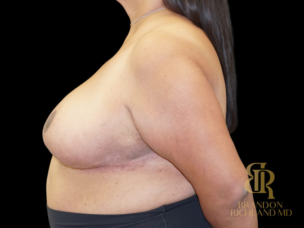 Breast Lift After, Case #42145, view 5 — Dr. Brandon Richland, Newport Beach