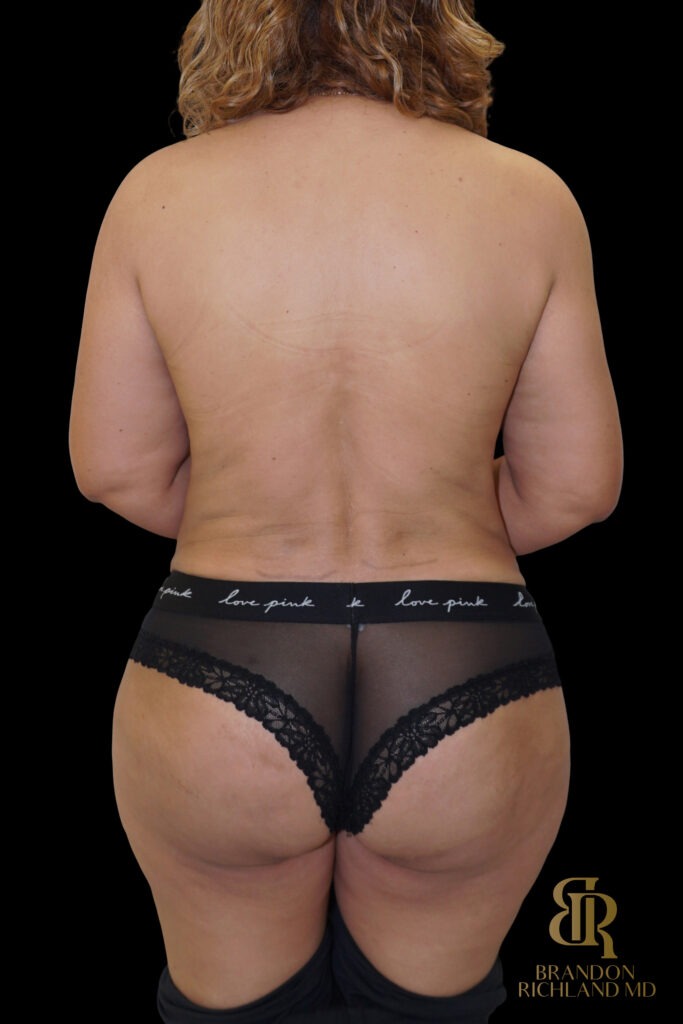 Tummy Tuck After, Case #70422, view 6 — Dr. Brandon Richland, Newport Beach