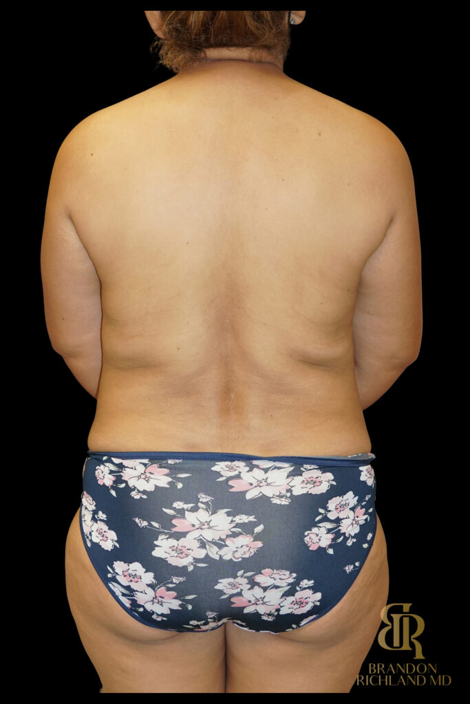 Tummy Tuck Before, Case #70422, view 6 — Dr. Brandon Richland, Newport Beach