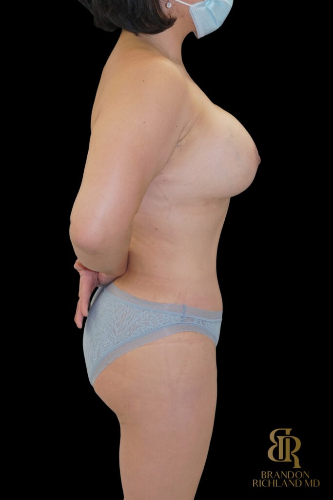 Liposuction After, Case #27969, view 3 — Dr. Brandon Richland, Newport Beach