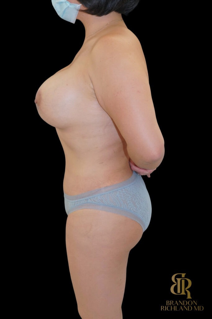 Liposuction After, Case #27969, view 5 — Dr. Brandon Richland, Newport Beach