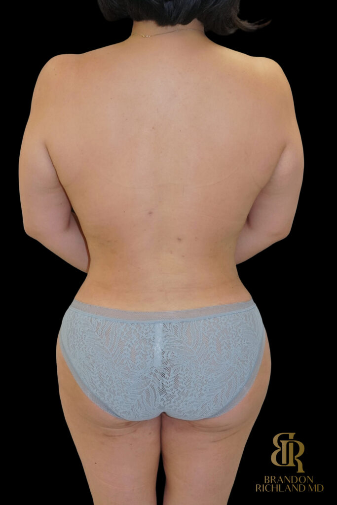 Liposuction After, Case #27969, view 6 — Dr. Brandon Richland, Newport Beach