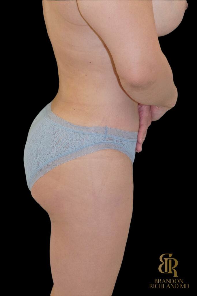 Liposuction After, Case #27969, view 8 — Dr. Brandon Richland, Newport Beach