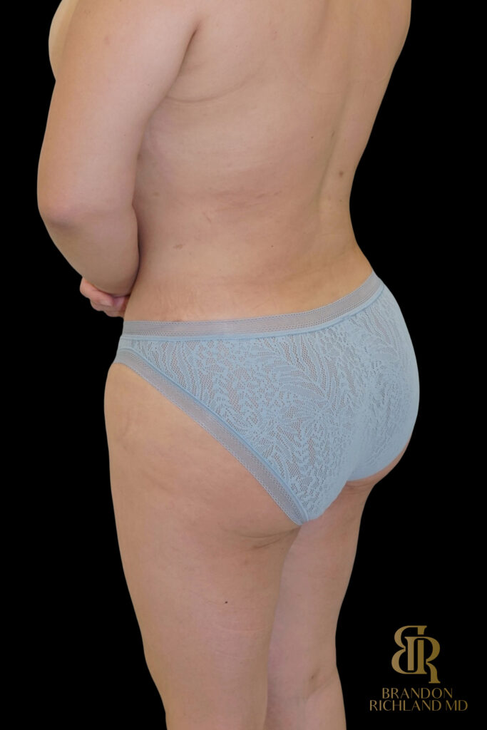 Liposuction After, Case #27969, view 9 — Dr. Brandon Richland, Newport Beach