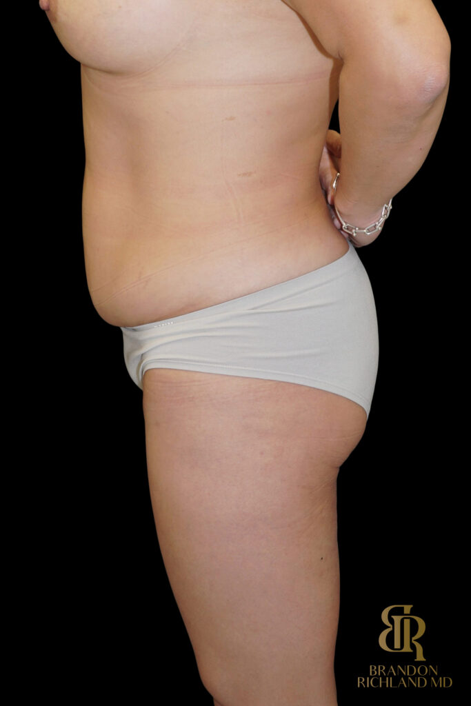 Liposuction Before, Case #27969, view 10 — Dr. Brandon Richland, Newport Beach