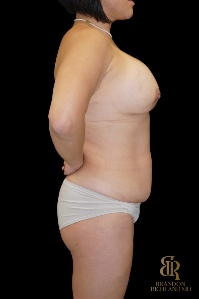 Liposuction Before, Case #27969, view 3 — Dr. Brandon Richland, Newport Beach