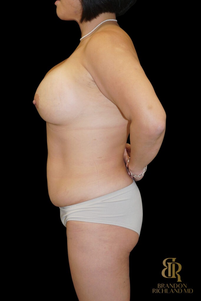 Liposuction Before, Case #27969, view 5 — Dr. Brandon Richland, Newport Beach