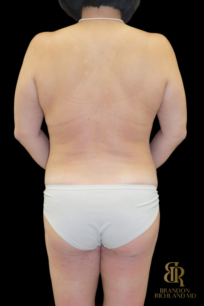 Liposuction Before, Case #27969, view 6 — Dr. Brandon Richland, Newport Beach