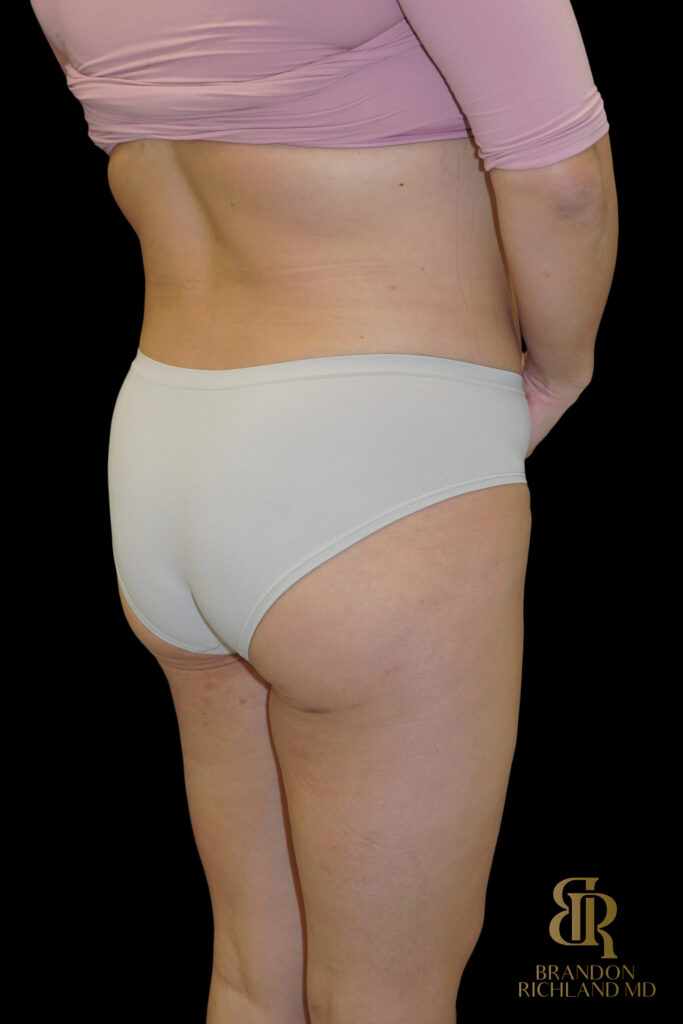 Liposuction Before, Case #27969, view 7 — Dr. Brandon Richland, Newport Beach