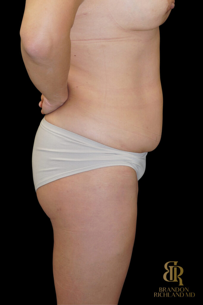 Liposuction Before, Case #27969, view 8 — Dr. Brandon Richland, Newport Beach