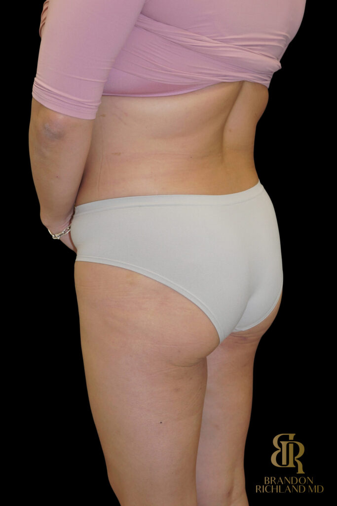 Liposuction Before, Case #27969, view 9 — Dr. Brandon Richland, Newport Beach