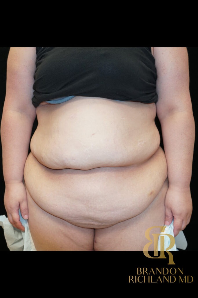 Tummy Tuck Before, Patient 01, view 1 — Dr. Brandon Richland, Newport Beach