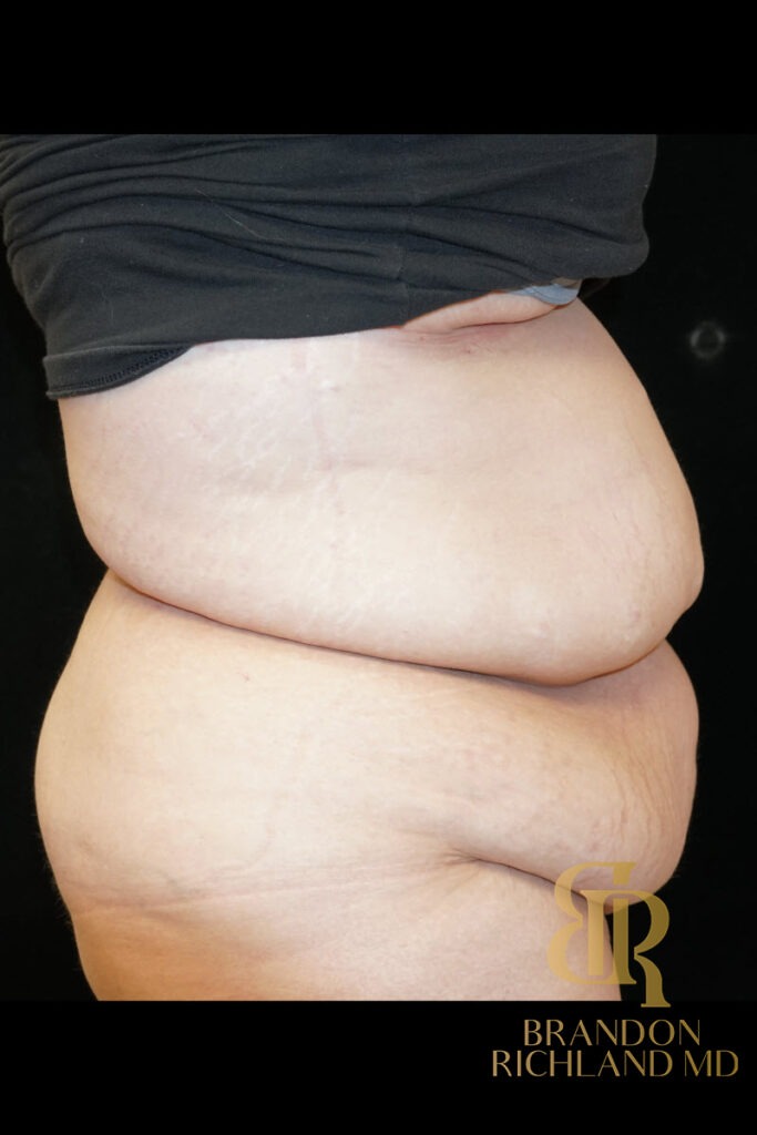 Tummy Tuck Before, Patient 01, view 3 — Dr. Brandon Richland, Newport Beach