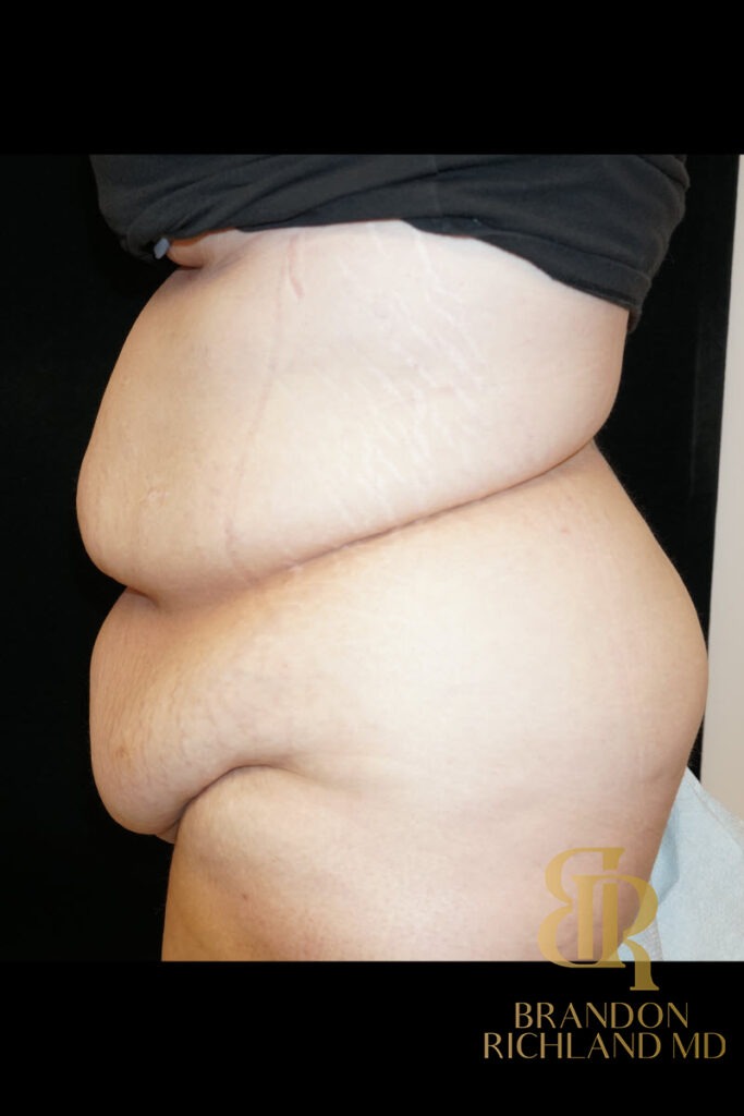 Tummy Tuck Before, Patient 01, view 5 — Dr. Brandon Richland, Newport Beach