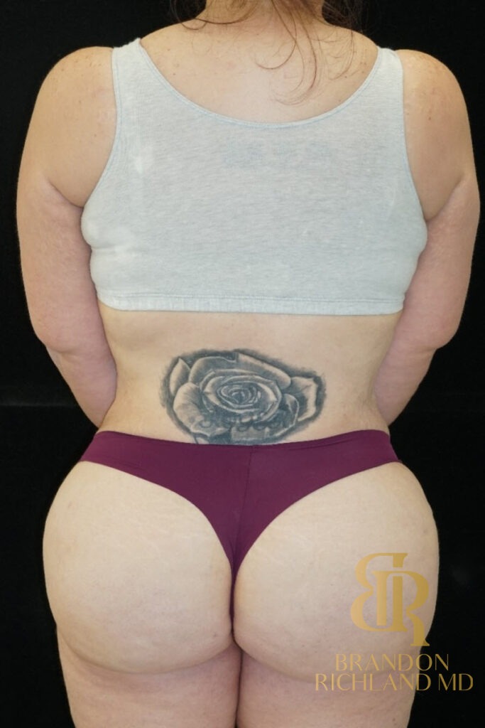Tummy Tuck After, Patient 01, view 6 — Dr. Brandon Richland, Newport Beach