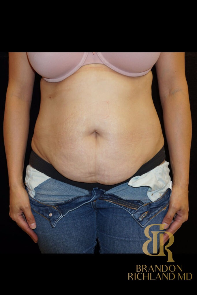 Tummy Tuck Before, Patient 02, view 1 — Dr. Brandon Richland, Newport Beach