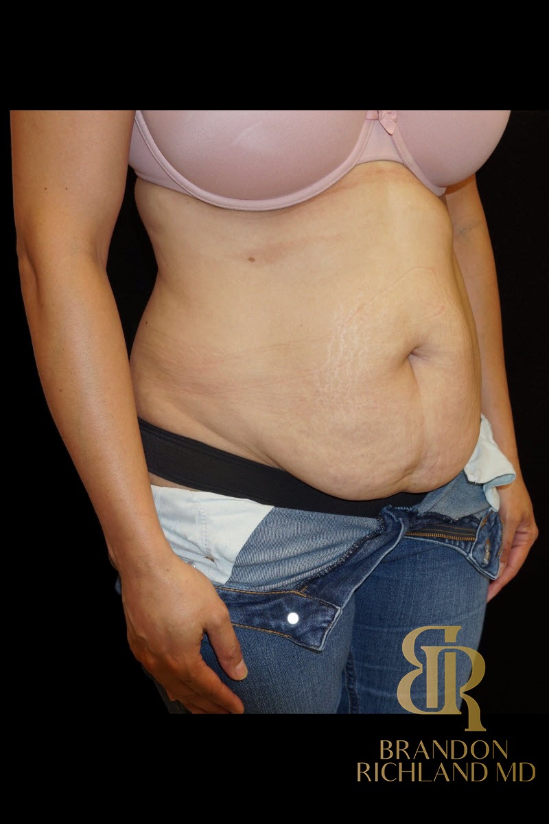 Tummy Tuck before and after, Patient 02 — Dr. Brandon Richland, Newport Beach