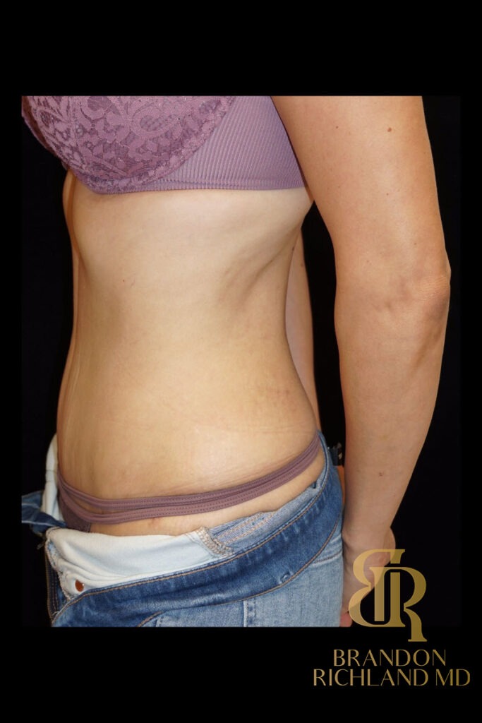 Tummy Tuck After, Patient 02, view 5 — Dr. Brandon Richland, Newport Beach