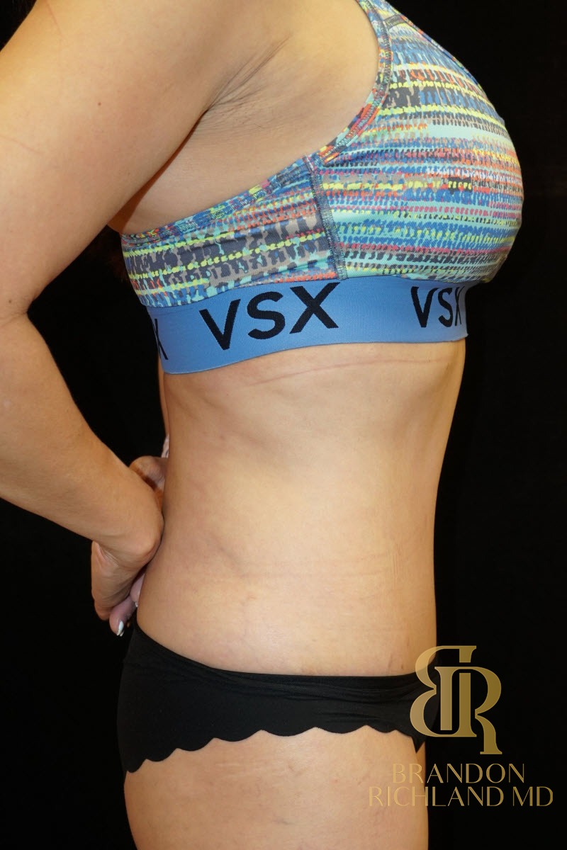 Tummy Tuck before and after, Patient 03 — Dr. Brandon Richland, Newport Beach