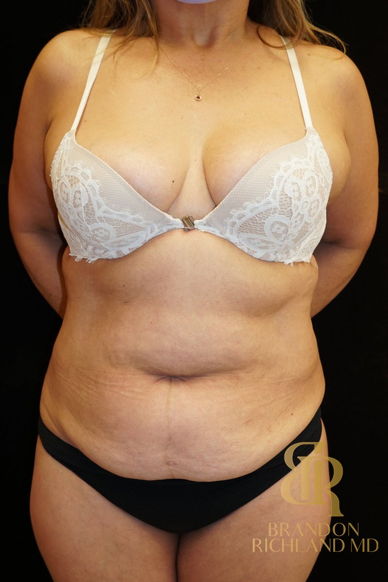 Tummy Tuck before and after, Patient 06 — Dr. Brandon Richland, Newport Beach
