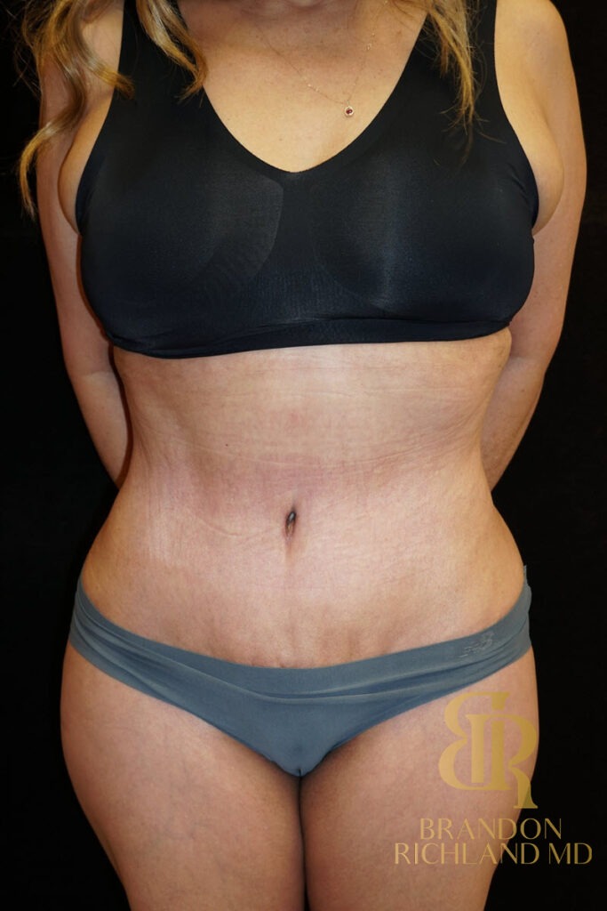 Tummy Tuck After, Patient 06, view 1 — Dr. Brandon Richland, Newport Beach