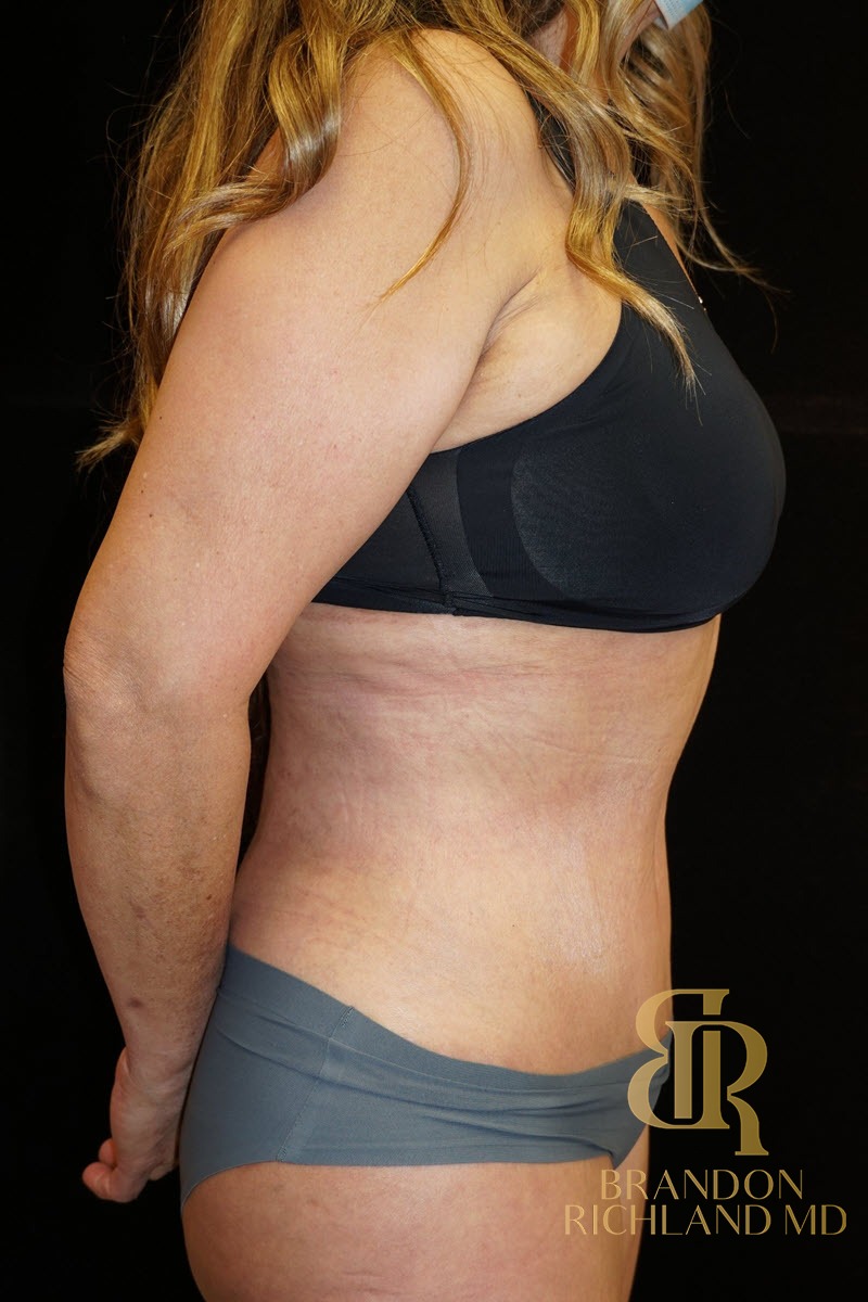 Tummy Tuck before and after, Patient 06 — Dr. Brandon Richland, Newport Beach