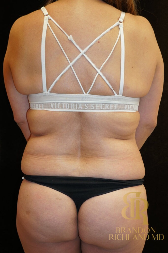 Tummy Tuck Before, Patient 06, view 4 — Dr. Brandon Richland, Newport Beach