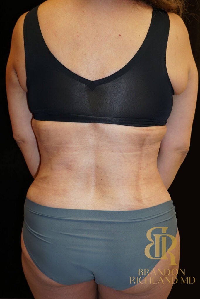 Tummy Tuck After, Patient 06, view 4 — Dr. Brandon Richland, Newport Beach