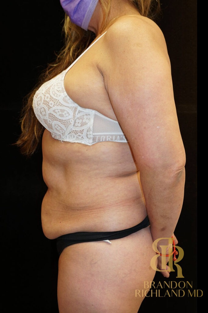 Tummy Tuck Before, Patient 06, view 5 — Dr. Brandon Richland, Newport Beach