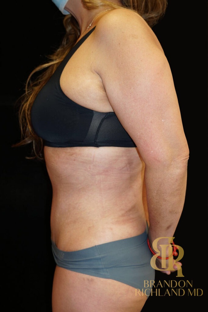 Tummy Tuck After, Patient 06, view 5 — Dr. Brandon Richland, Newport Beach