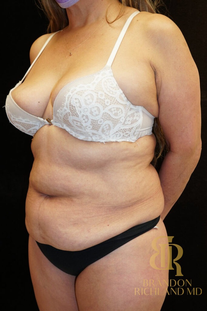 Tummy Tuck Before, Patient 06, view 6 — Dr. Brandon Richland, Newport Beach