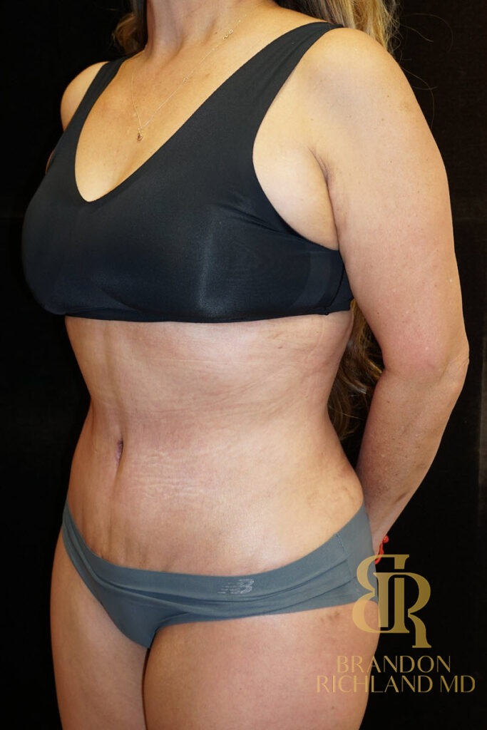 Tummy Tuck After, Patient 06, view 6 — Dr. Brandon Richland, Newport Beach