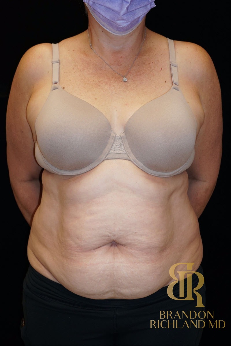 Tummy Tuck before and after, Patient 07 — Dr. Brandon Richland, Newport Beach