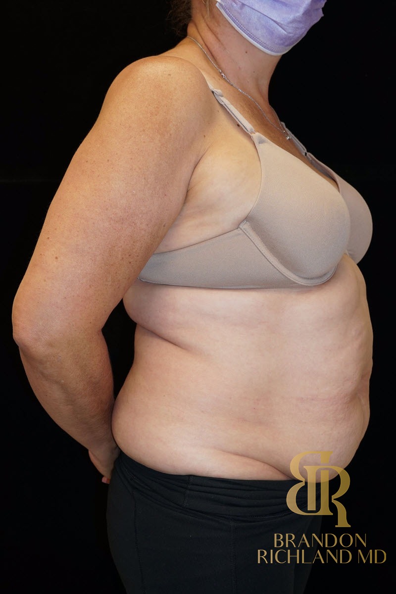 Tummy Tuck before and after, Patient 07 — Dr. Brandon Richland, Newport Beach