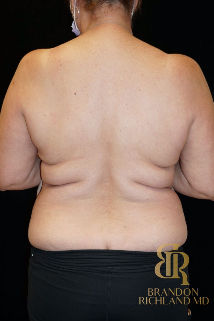 Tummy Tuck Before, Patient 07, view 4 — Dr. Brandon Richland, Newport Beach