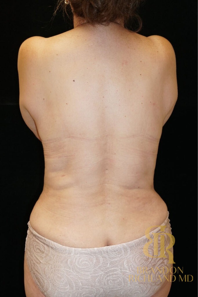 Tummy Tuck After, Patient 07, view 4 — Dr. Brandon Richland, Newport Beach