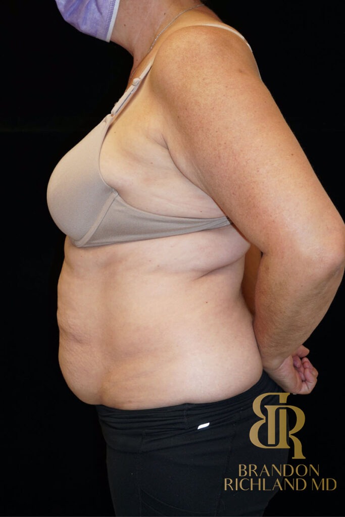 Tummy Tuck Before, Patient 07, view 5 — Dr. Brandon Richland, Newport Beach