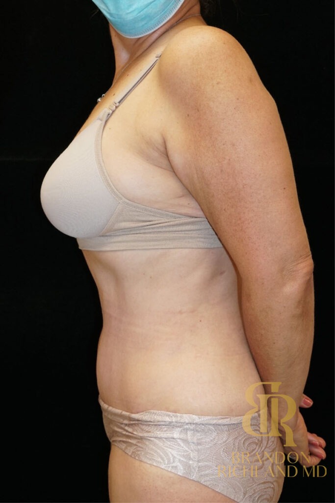 Tummy Tuck After, Patient 07, view 5 — Dr. Brandon Richland, Newport Beach