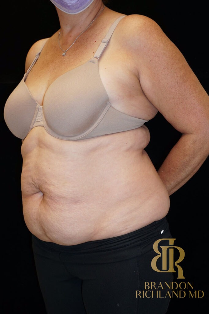 Tummy Tuck Before, Patient 07, view 6 — Dr. Brandon Richland, Newport Beach