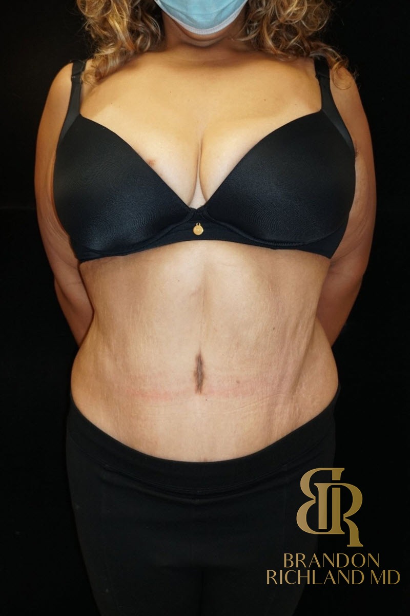 Tummy Tuck before and after, Patient 08 — Dr. Brandon Richland, Newport Beach