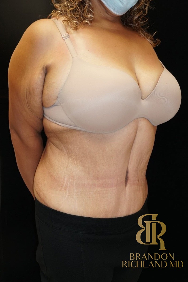 Tummy Tuck before and after, Patient 08 — Dr. Brandon Richland, Newport Beach