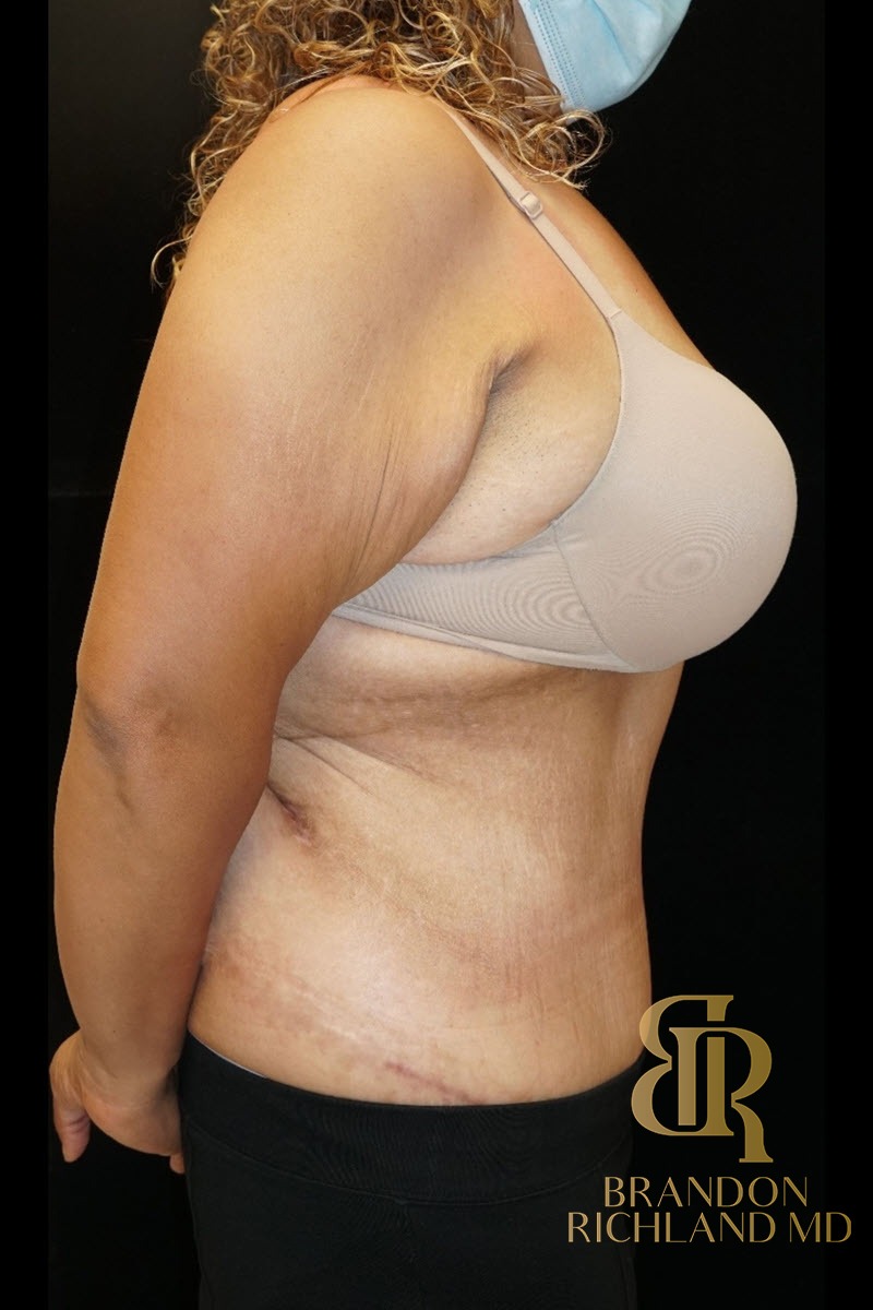 Tummy Tuck before and after, Patient 08 — Dr. Brandon Richland, Newport Beach