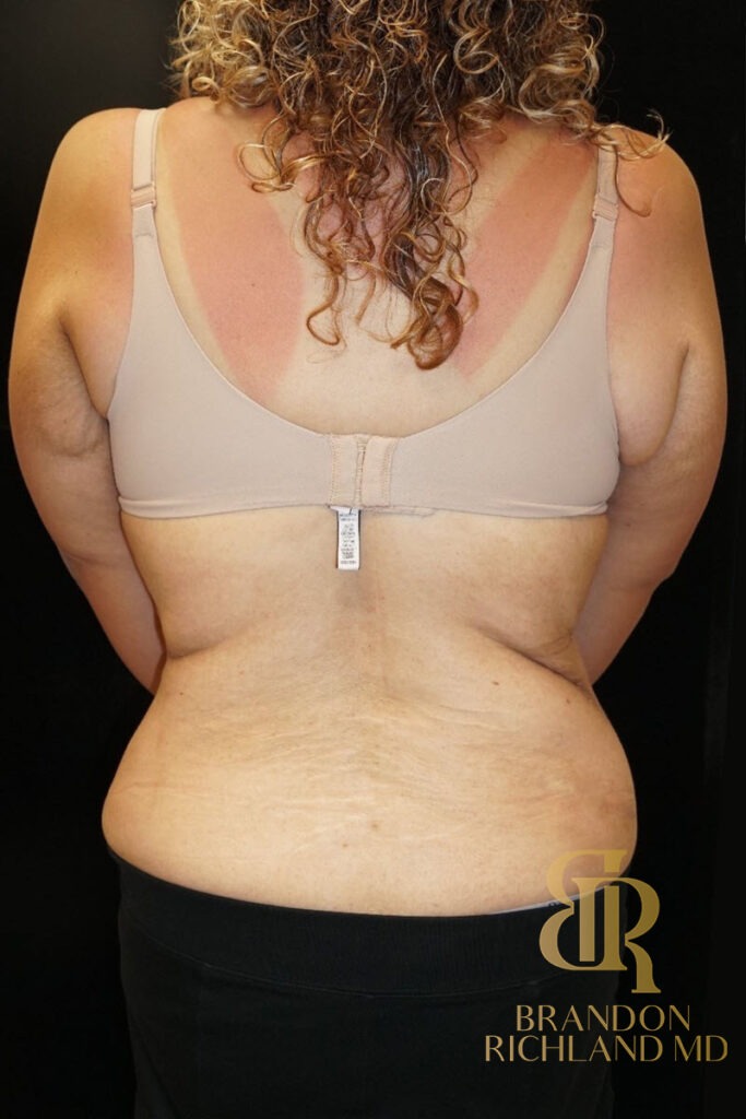 Tummy Tuck After, Patient 08, view 4 — Dr. Brandon Richland, Newport Beach
