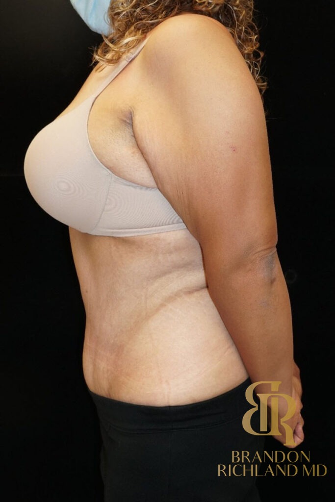 Tummy Tuck After, Patient 08, view 5 — Dr. Brandon Richland, Newport Beach