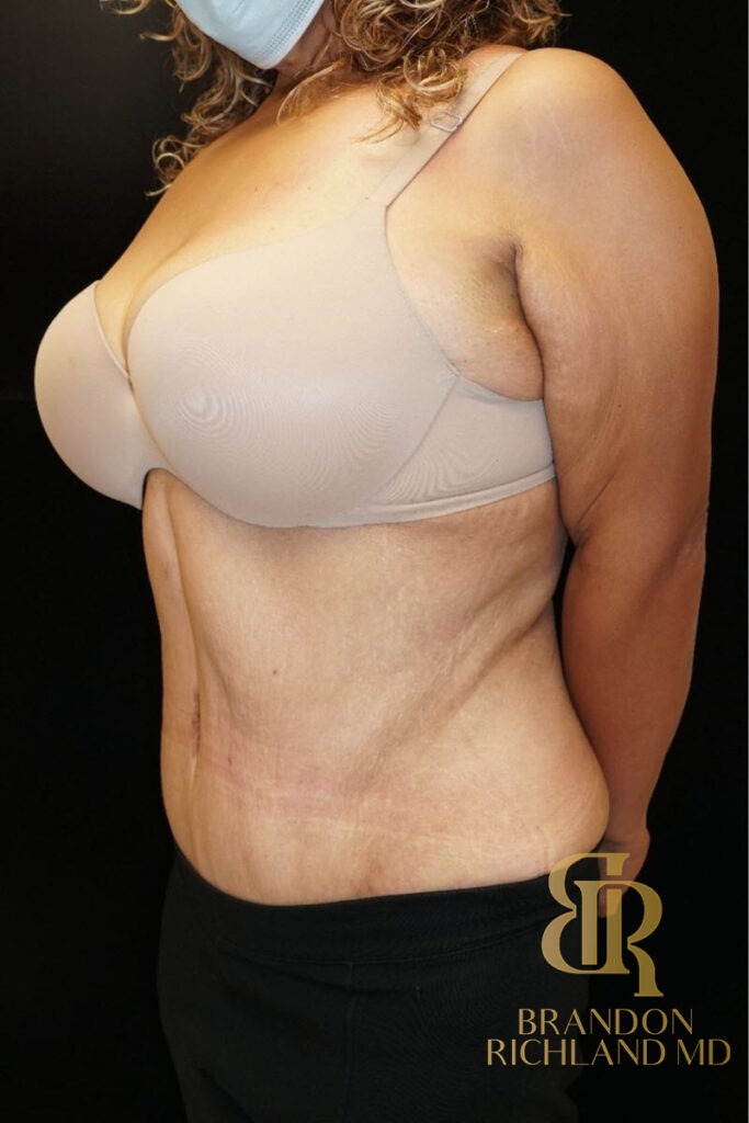 Tummy Tuck After, Patient 08, view 6 — Dr. Brandon Richland, Newport Beach