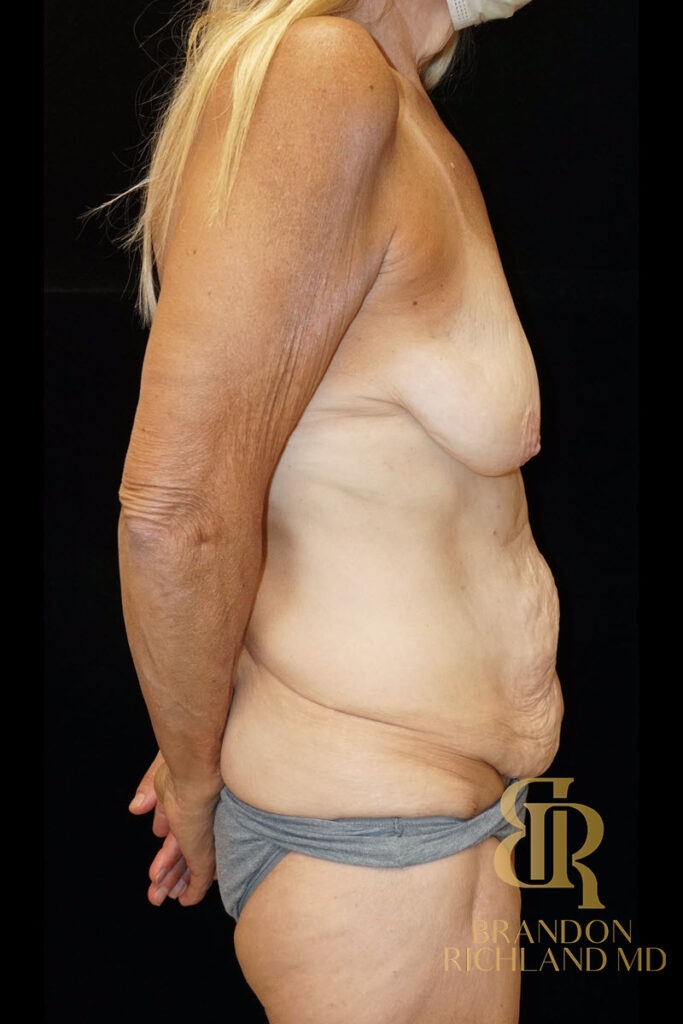 Tummy Tuck Before, Patient 09, view 3 — Dr. Brandon Richland, Newport Beach
