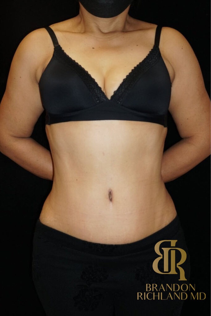 Tummy Tuck After, Patient 10, view 1 — Dr. Brandon Richland, Newport Beach