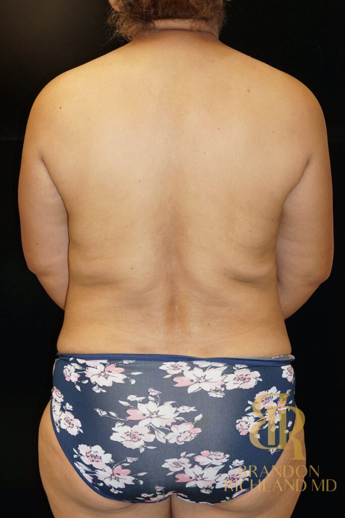 Tummy Tuck Before, Patient 10, view 4 — Dr. Brandon Richland, Newport Beach