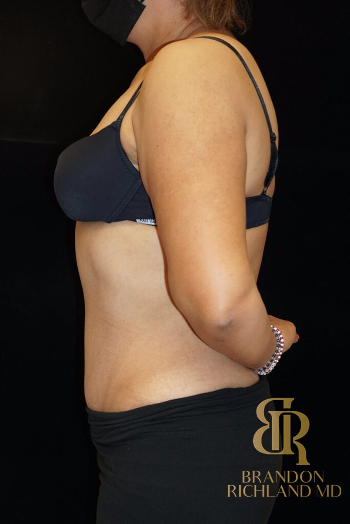 Tummy Tuck After, Patient 10, view 5 — Dr. Brandon Richland, Newport Beach
