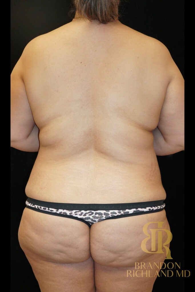 Tummy Tuck Before, Patient 12, view 6 — Dr. Brandon Richland, Newport Beach